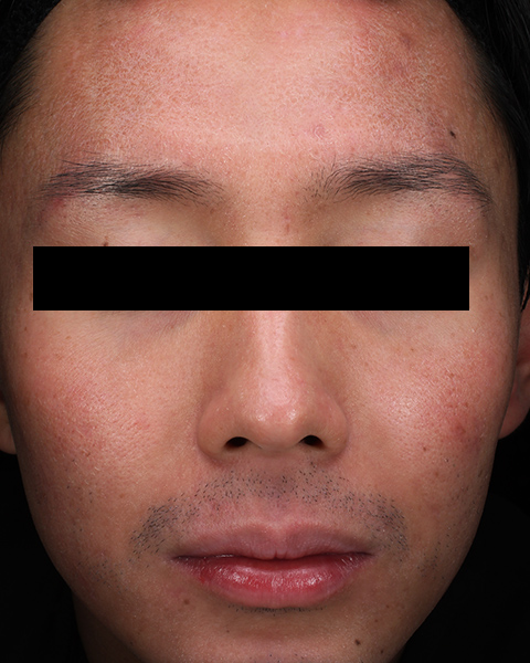 イソトレチノイン（アキュテイン）服用後 5か月 顔の正面