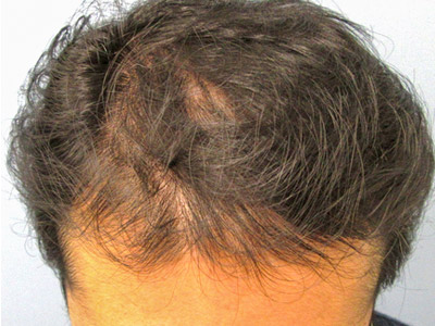 AGA・男性の薄毛治療（生え際・前頭部）2か月後