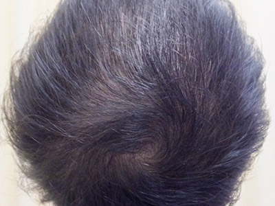 AGA・男性の薄毛治療（頭頂部）1か月後