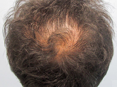 AGA・男性の薄毛治療（頭頂部）2か月後