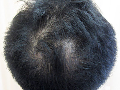 AGA・男性の薄毛治療（頭頂部）5か月後