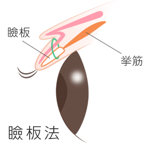 福岡・博多のあやべクリニックでは腫れが少ない瞼板法を採用
