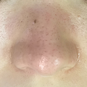 ハイドラフェイシャル（鼻の毛穴）施術後
