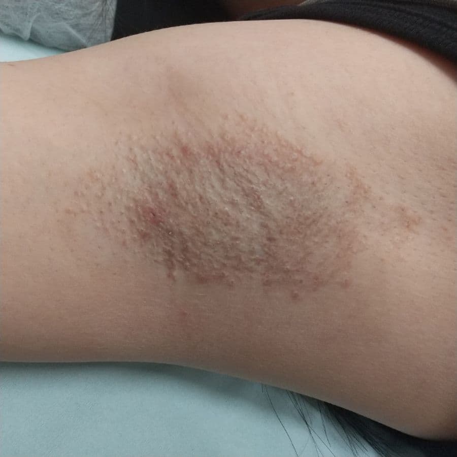 福岡のビューホット症例 30歳女性 施術後14日目の右わきの状態