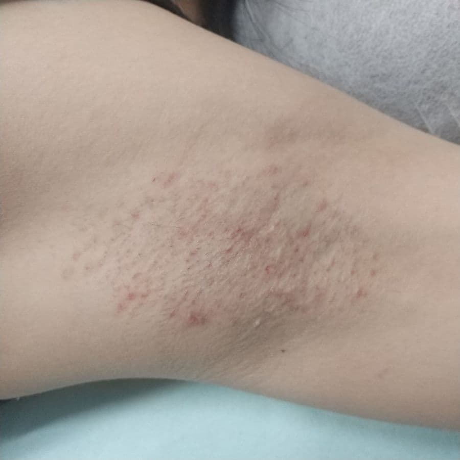 福岡のビューホット症例 13歳女性 施術後14日目の左わきの状態