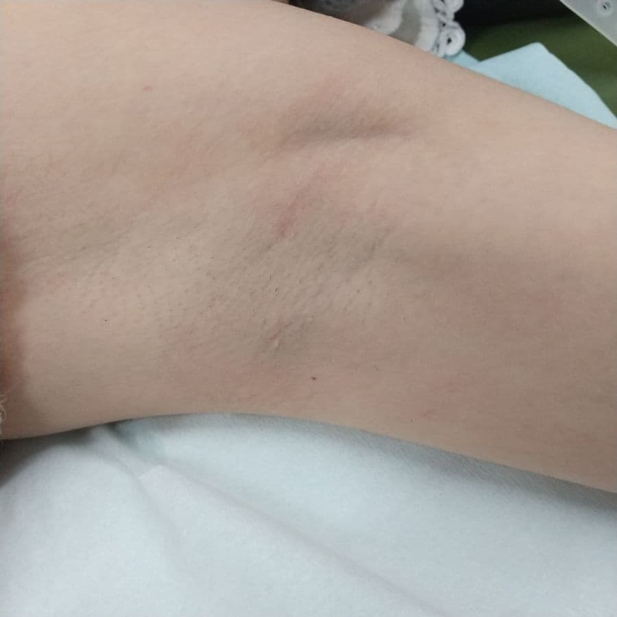 福岡のビューホット症例 13歳女性 施術前の左わきの状態