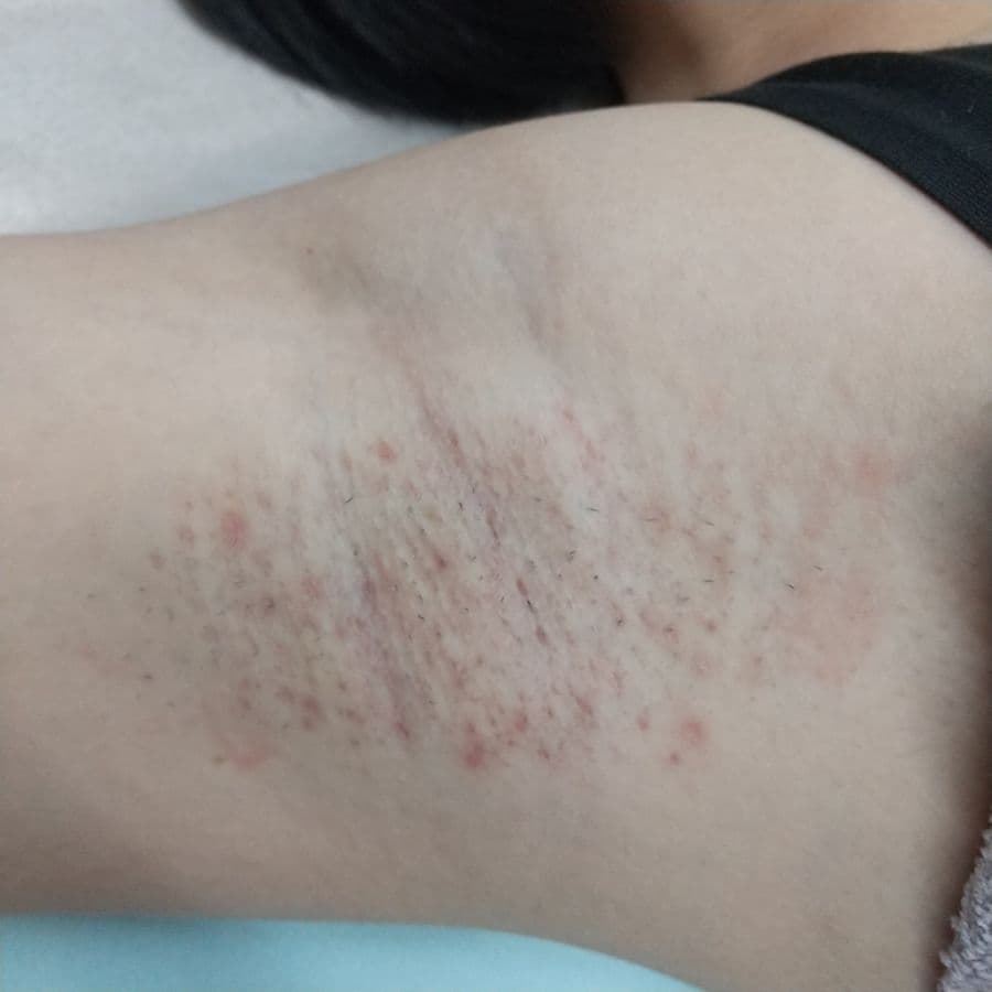 福岡のビューホット症例 16歳女性 施術後14日目の右わきの状態