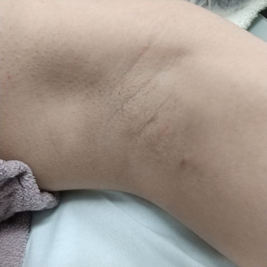 福岡のビューホット症例 16歳女性 施術前の左わきの状態