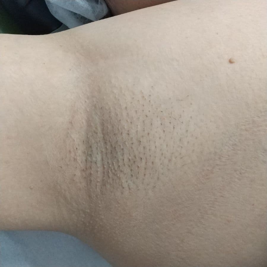 福岡の50代女性ワキガ治療症例 施術前の右わきの状態