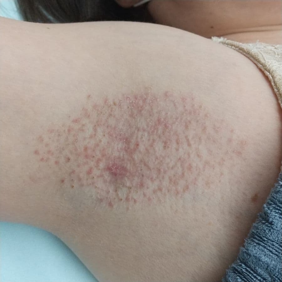 福岡のワキガ他院修正症例 53歳女性 施術後14日目の右わきの状態