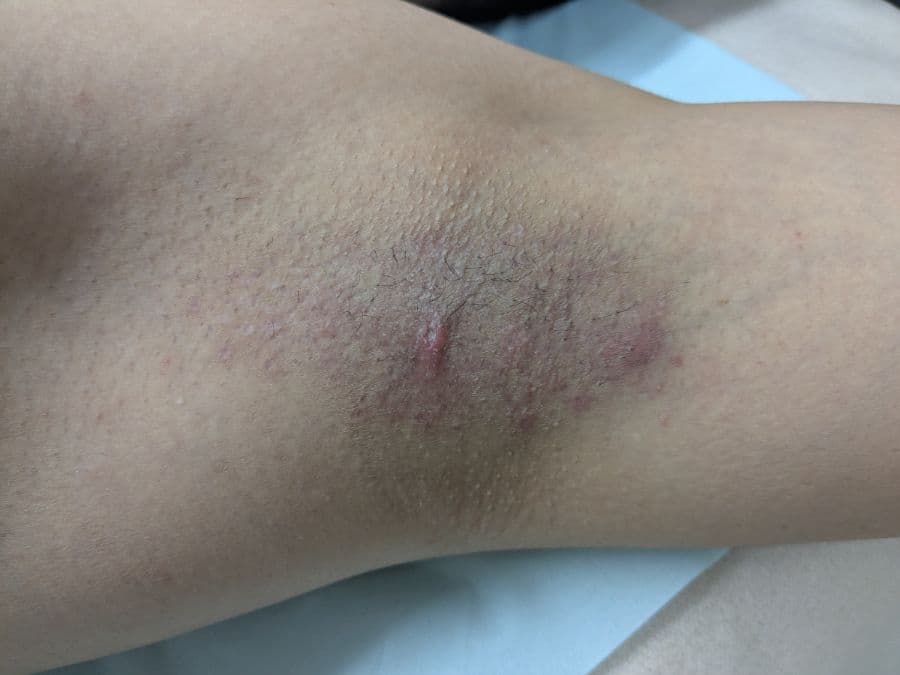 福岡のメンズワキガ治療症例 47歳男性 施術後14日目の左わきの状態