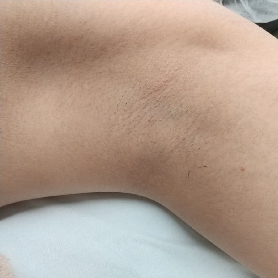 福岡のメンズワキガ治療症例 47歳男性 施術前の左わきの状態