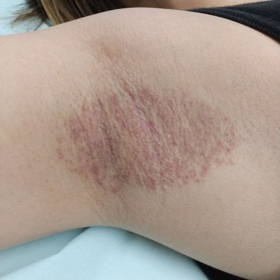 福岡のワキガ他院修正症例 34歳女性 施術後14日目の右わきの状態