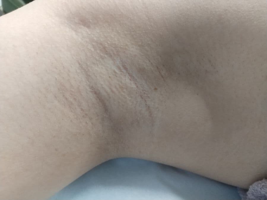 福岡のワキガ他院修正症例 34歳女性 施術前の右わきの状態