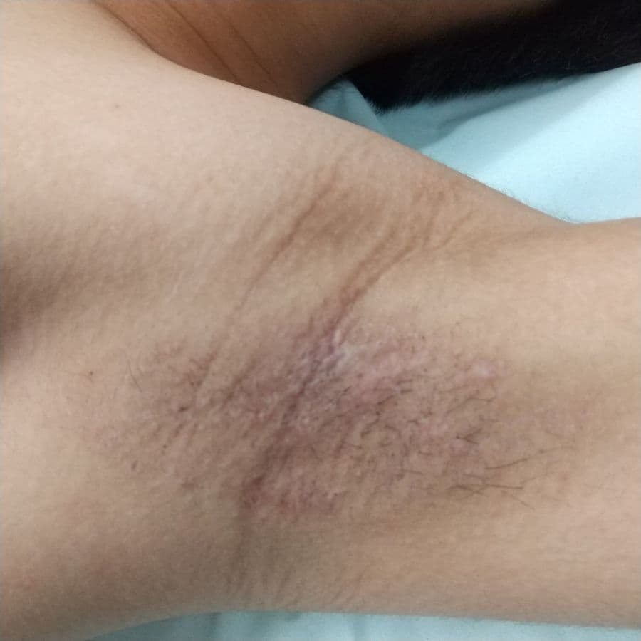 福岡の高校生ワキガ治療症例 16歳男性 施術後14日目の左わきの状態