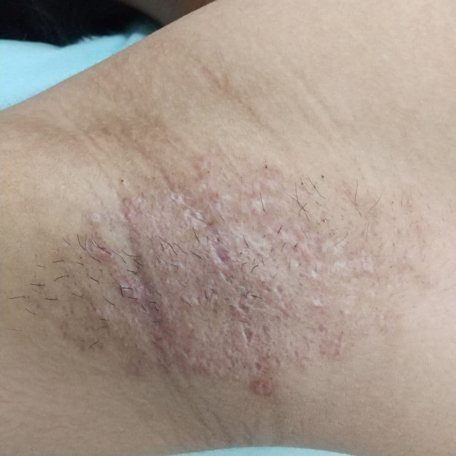 福岡の高校生ワキガ治療症例 16歳男性 施術後14日目の右わきの状態