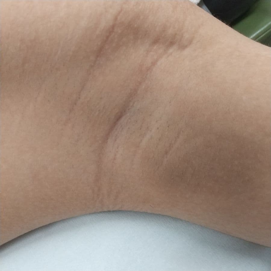 福岡の高校生ワキガ治療症例 16歳男性 施術前の左わきの状態