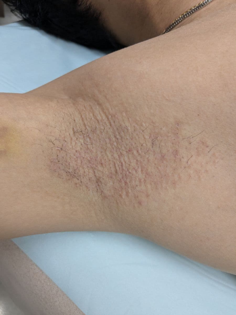 福岡のメンズワキガ治療症例 42歳男性 施術後14日目の右わきの状態