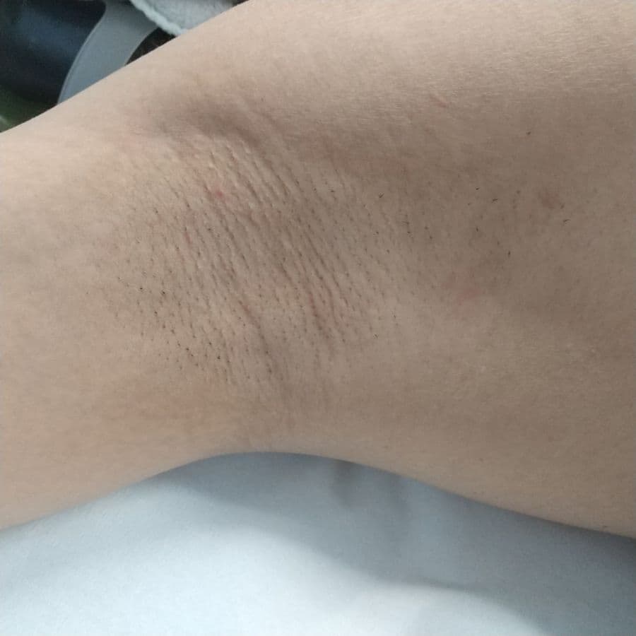 福岡のメンズワキガ治療症例 42歳男性 施術前の右わきの状態