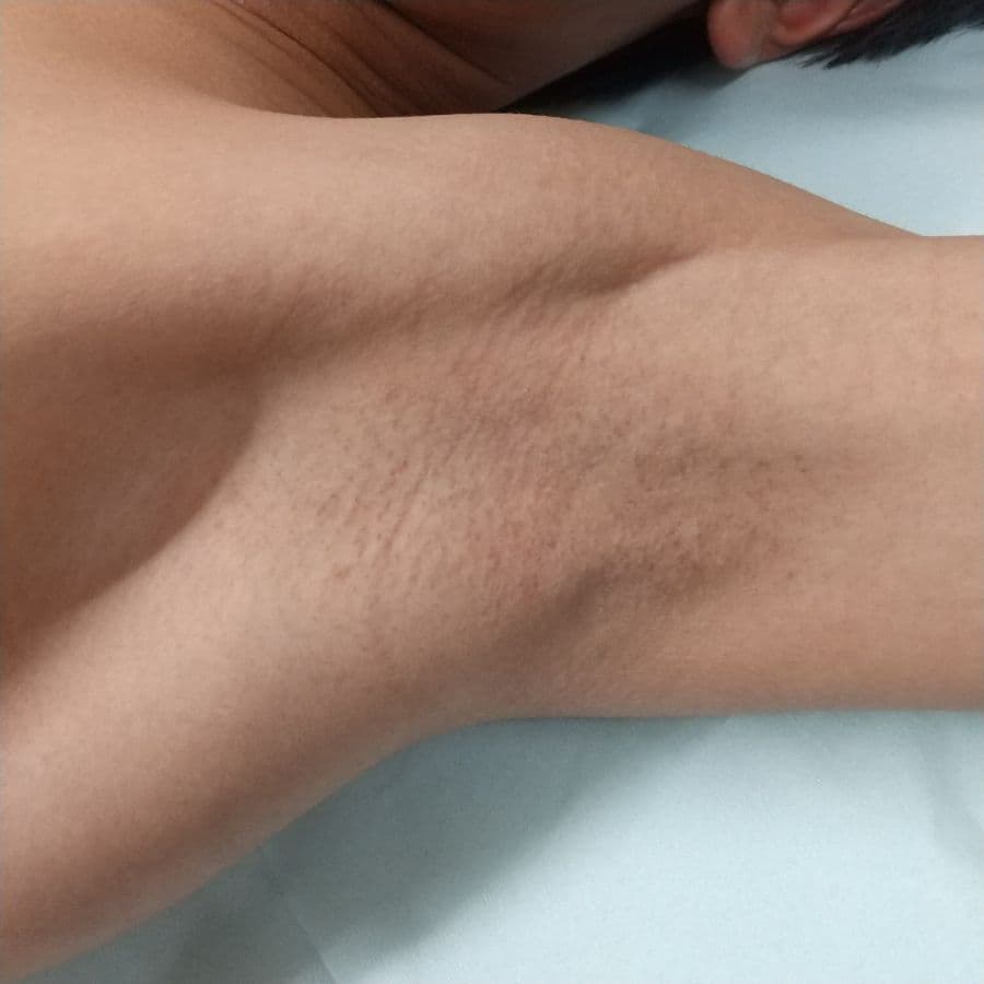 福岡の子供ワキガ治療症例 12歳男子 施術後14日目の左わきの状態