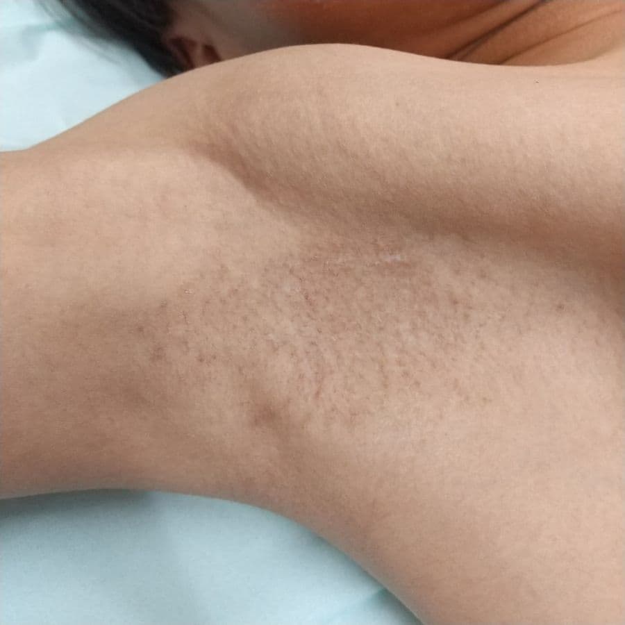 福岡の子供ワキガ治療症例 12歳男子 施術後14日目の右わきの状態