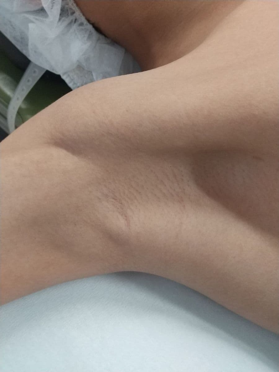 福岡の子供ワキガ治療症例 12歳男子 施術前の右わきの状態