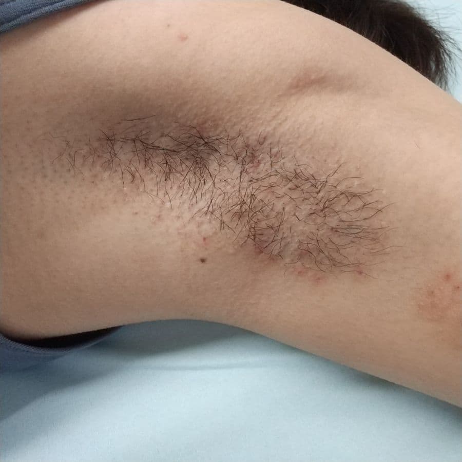 福岡の重度ワキガ治療症例 16歳女性 施術後14日目の左わきの状態