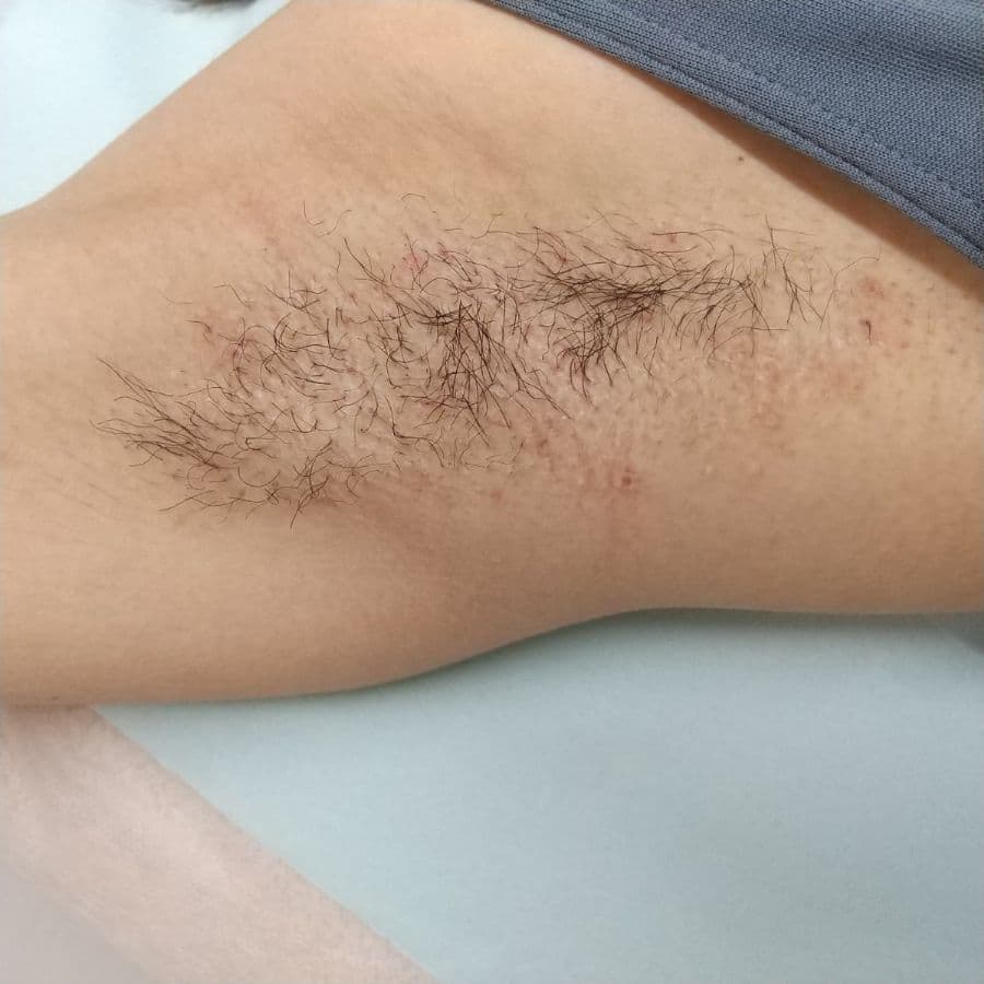 福岡の重度ワキガ治療症例 16歳女性 施術後14日目の右わきの状態