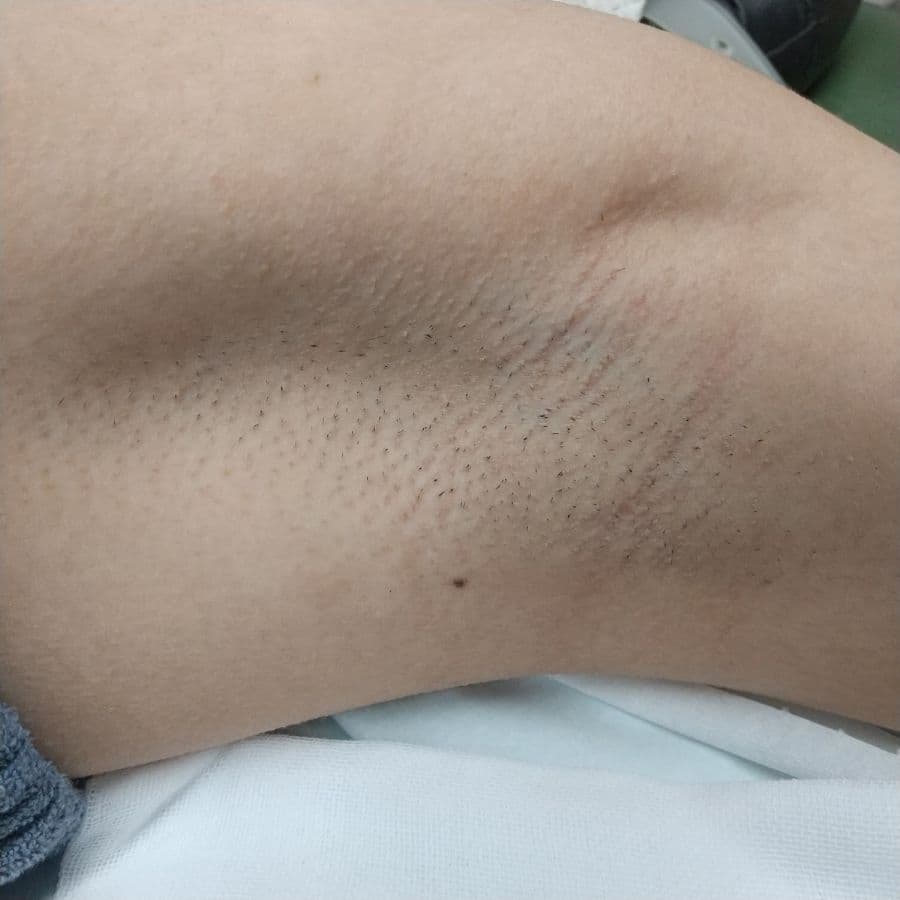 福岡の重度ワキガ治療症例 16歳女性 施術前の左わきの状態