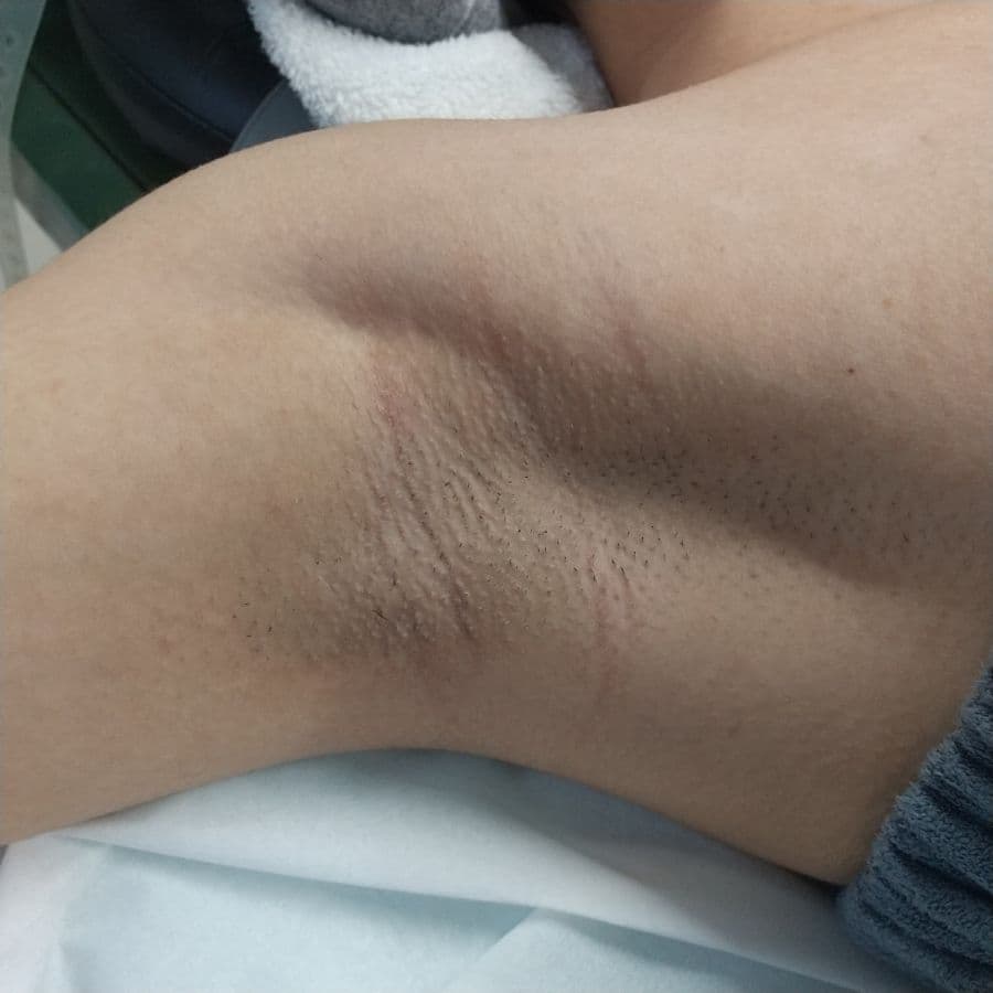 福岡の重度ワキガ治療症例 16歳女性 施術前の右わきの状態