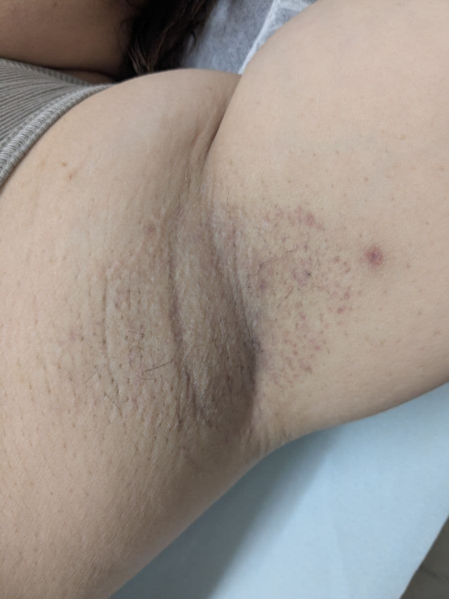 福岡のビューホット症例 39歳女性 施術後14日目の左わきの状態