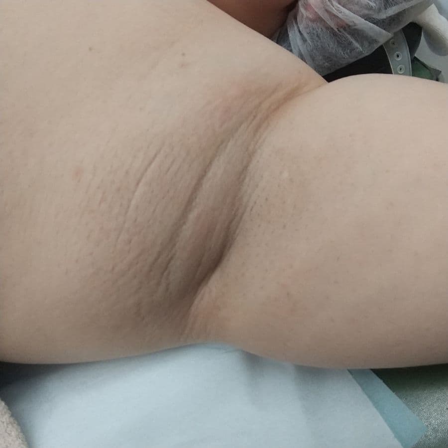 福岡のビューホット症例 39歳女性 施術前の左わきの状態