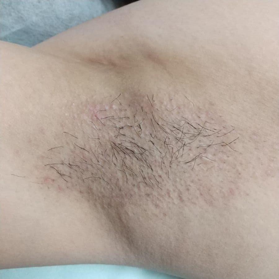 福岡のワキガ・多汗症治療症例 37歳男性 施術後14日目の右わきの状態