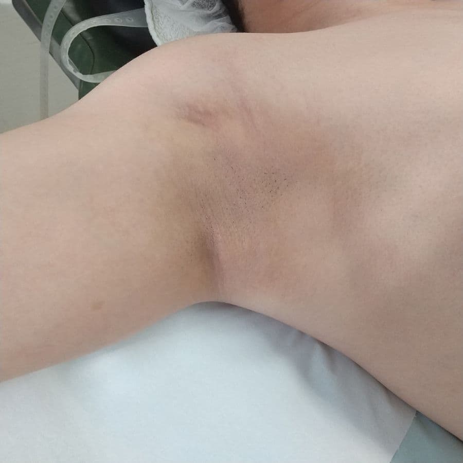 福岡のワキガ・多汗症治療症例 37歳男性 施術前の右わきの状態