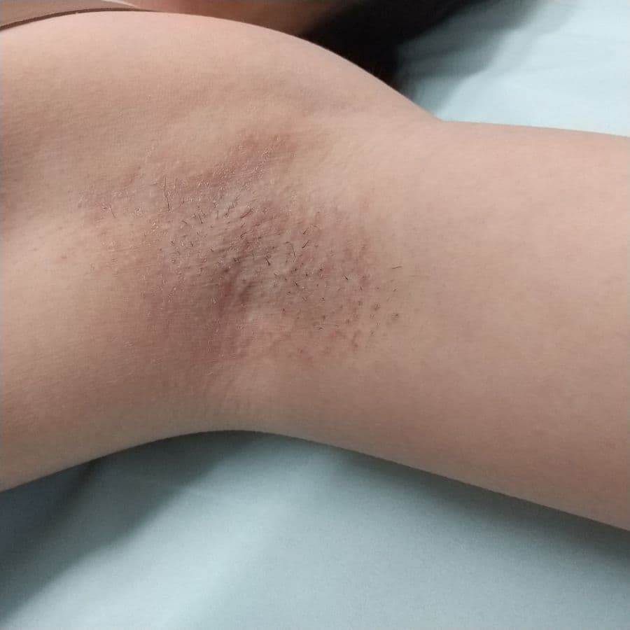 福岡の高校生ワキガ治療症例 18歳女性 施術後14日目の左わきの状態