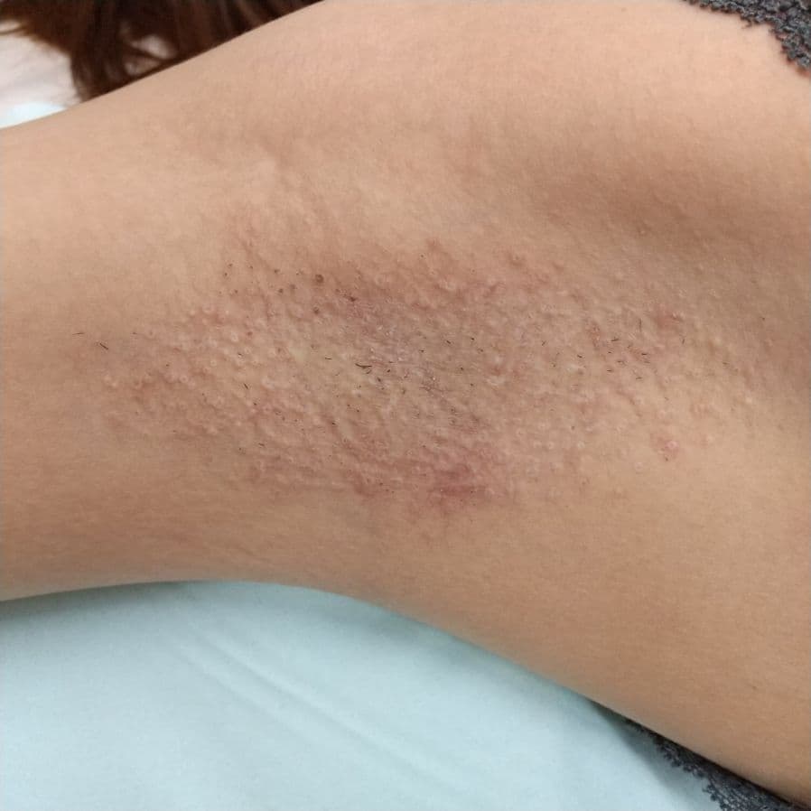 福岡のワキガ治療症例 32歳女性 施術後14日目の右わきの状態