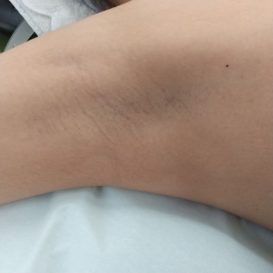 福岡のワキガ治療症例 32歳女性 施術前の右わきの状態