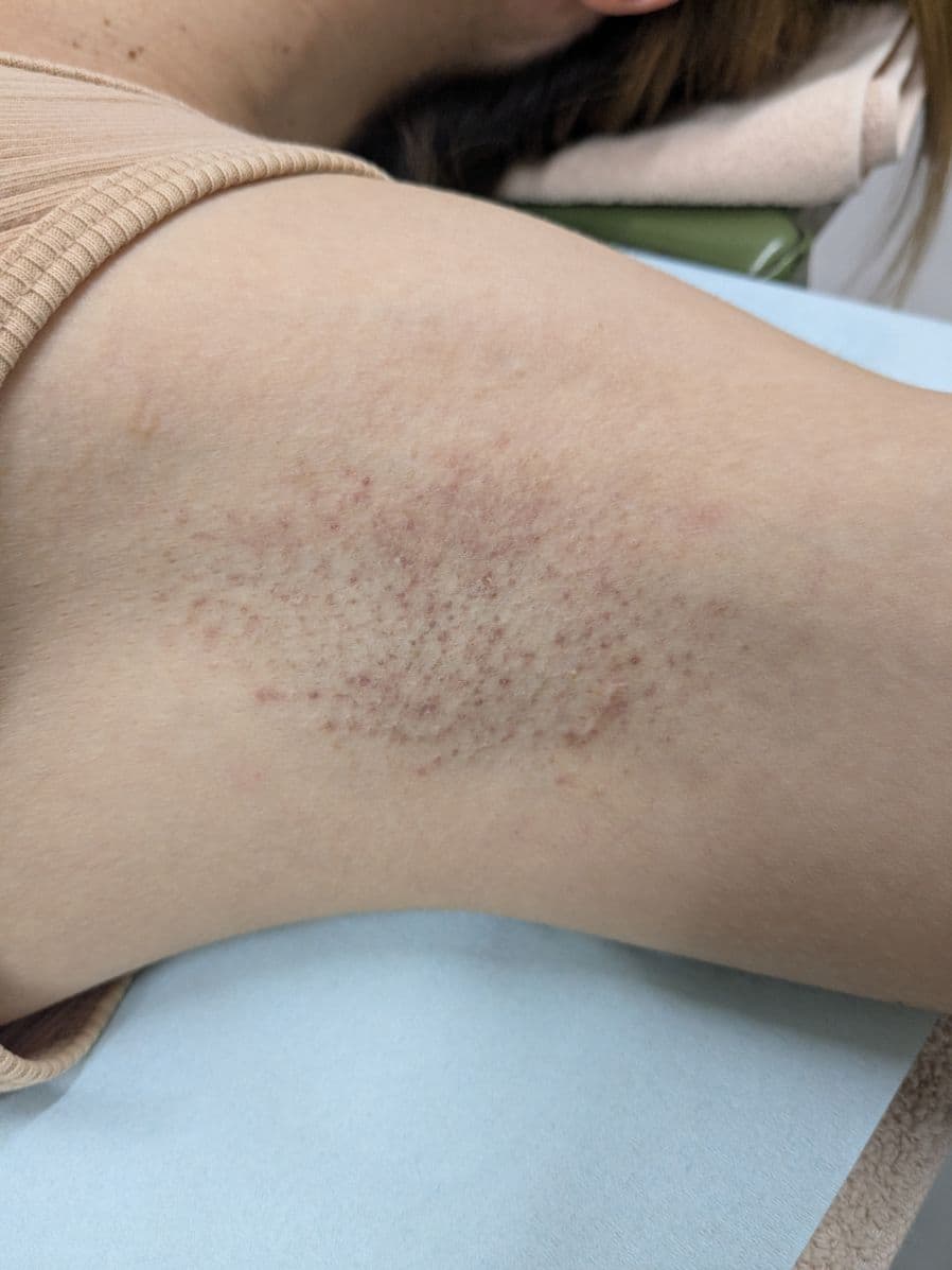 福岡のワキガ・多汗症治療症例 38歳女性 施術後14日目の左わきの状態