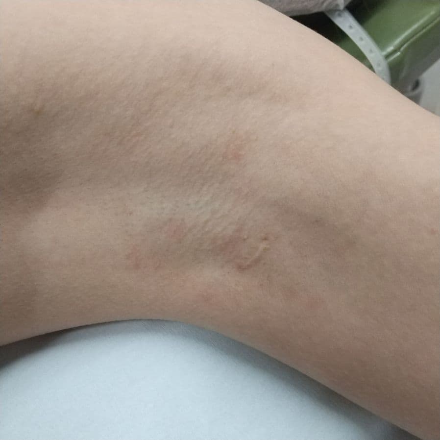 福岡のワキガ・多汗症治療症例 38歳女性 施術前の左わきの状態