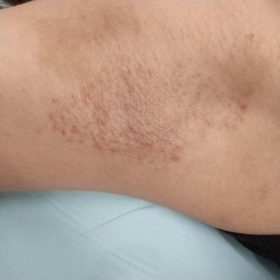 福岡のワキガ治療症例 23歳女性 施術後14日目の右わきの状態