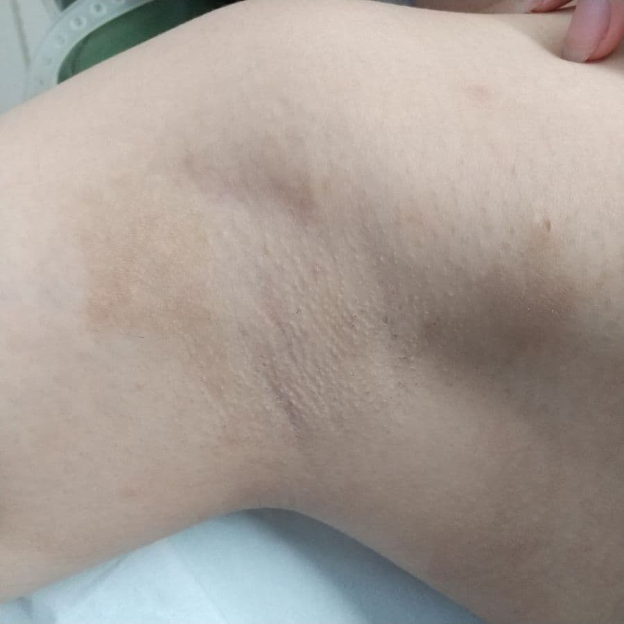 福岡のワキガ治療症例 23歳女性 施術前の右わきの状態