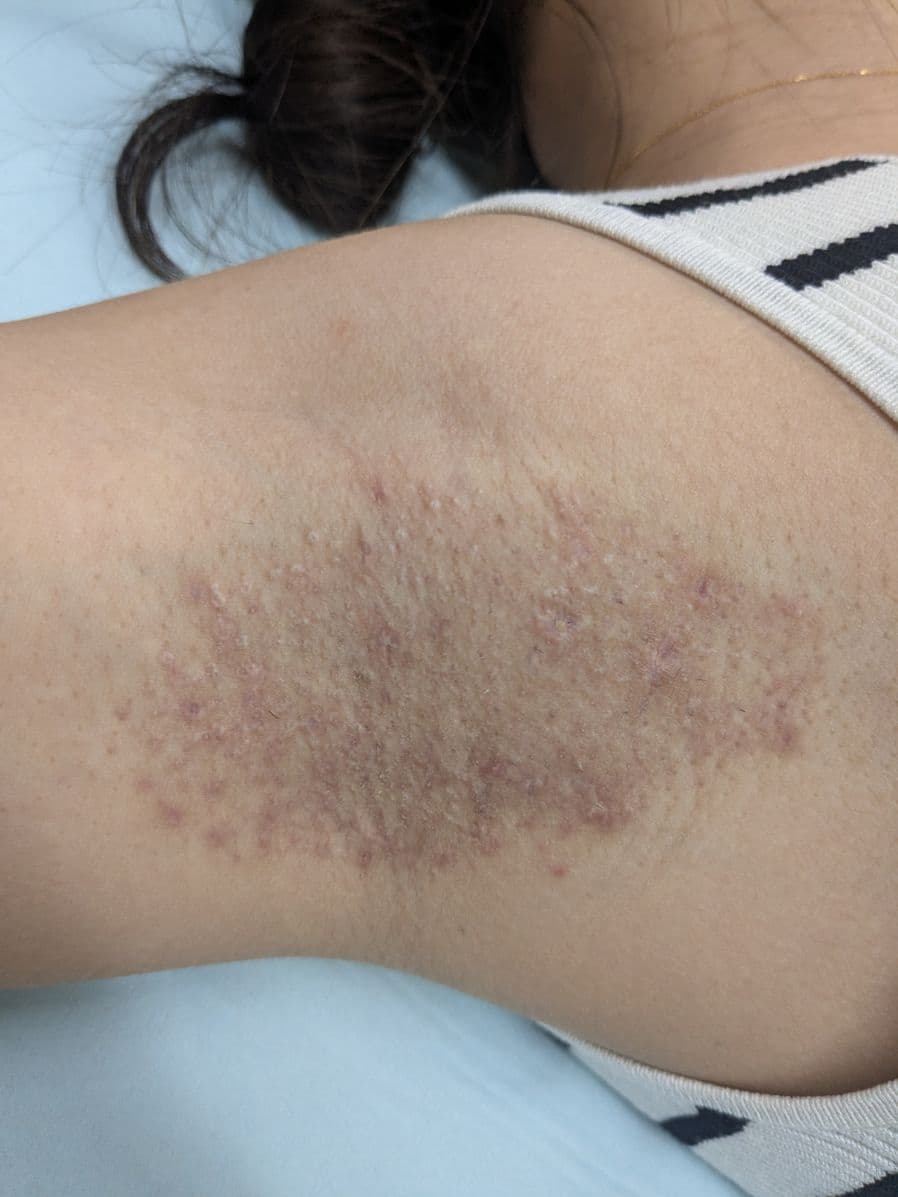 福岡の重度ワキガ治療症例 34歳女性 施術後14日目の右わきの状態