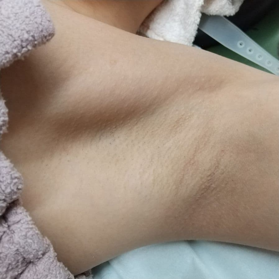 福岡のワキガ治療症例 27歳女性・サービス業 施術前の左わきの状態