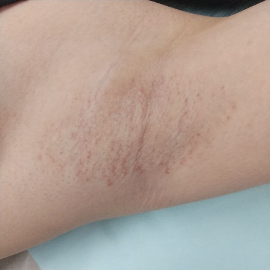 福岡のビューホット症例 13歳女性 施術後14日目の左わきの状態