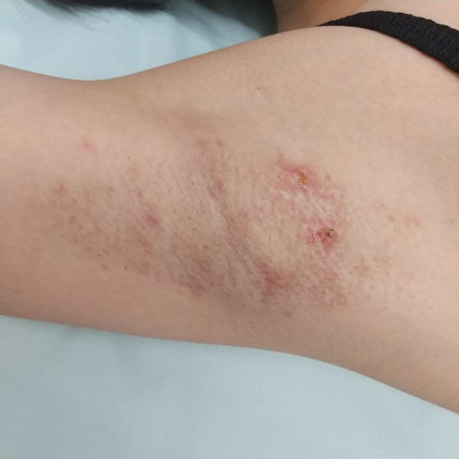 福岡のビューホット症例 13歳女性 施術後14日目の右わきの状態