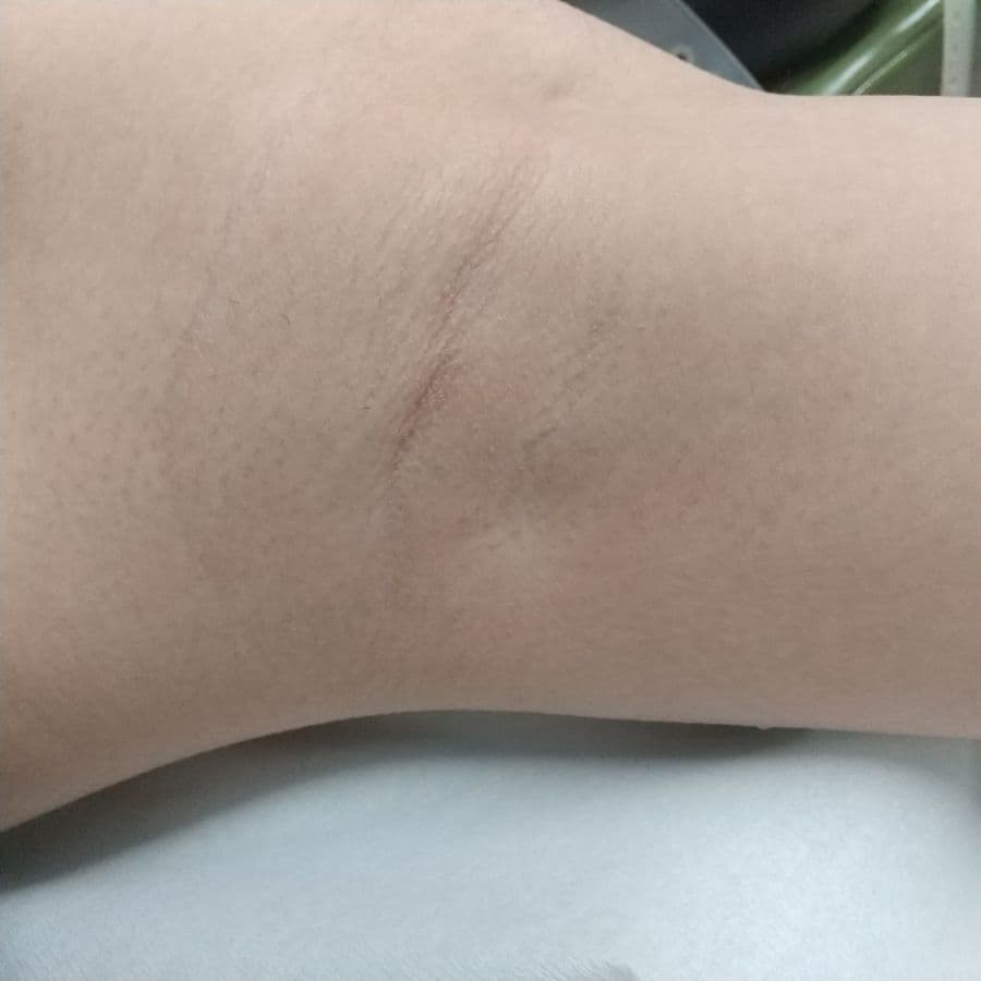 福岡のビューホット症例 13歳女性 施術前の左わきの状態