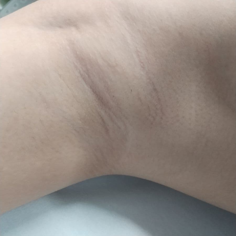 福岡のビューホット症例 13歳女性 施術前の右わきの状態