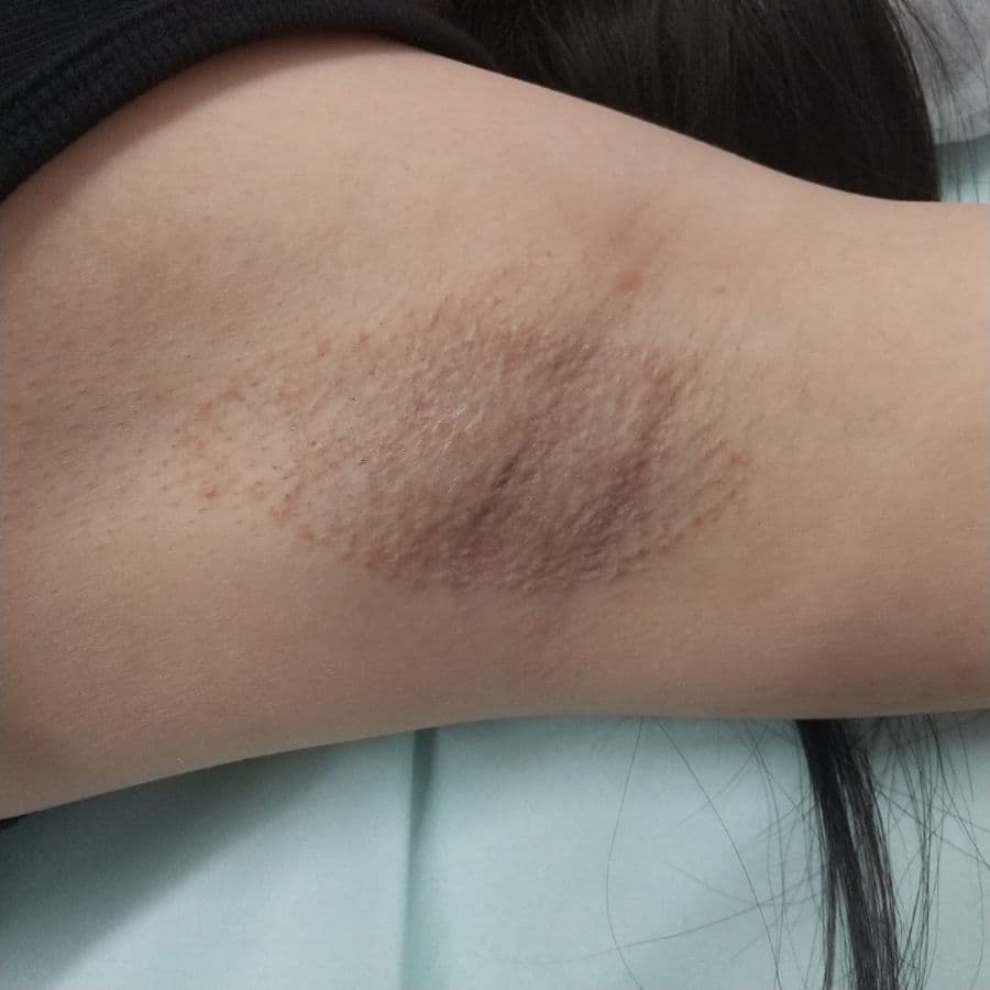 福岡のビューホット症例 30歳女性 施術後14日目の左わきの状態