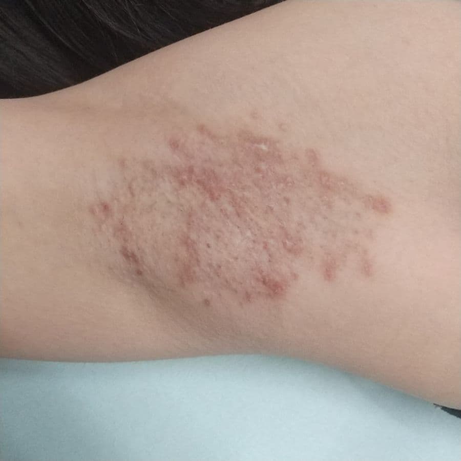 福岡のビューホット症例 13歳女性 施術後14日目の右わきの状態