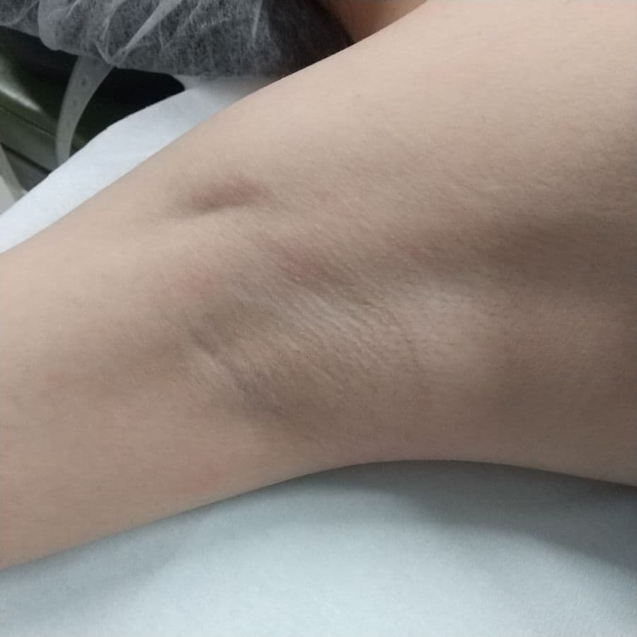 福岡のビューホット症例 13歳女性 施術前の右わきの状態